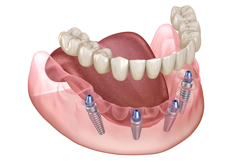All on X Dental Implants in Clovis