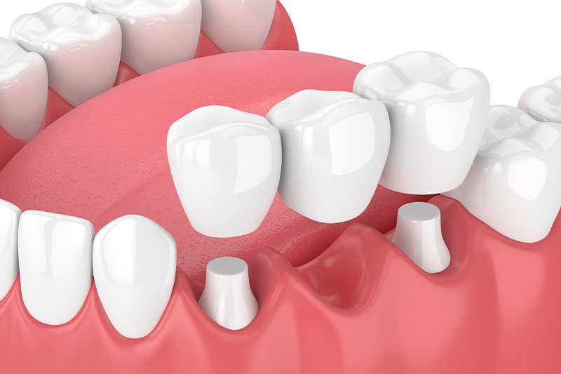 Zirconia Fixed Dental Bridges in Clovis