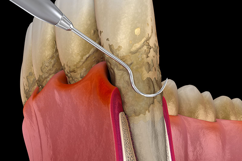 Periodontal Treatments in Clovis