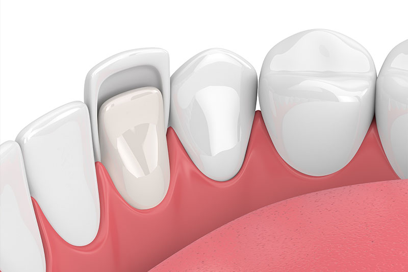 Porcelain Veneers in Clovis