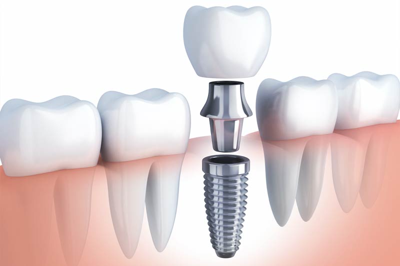 Implants Dentist in Clovis