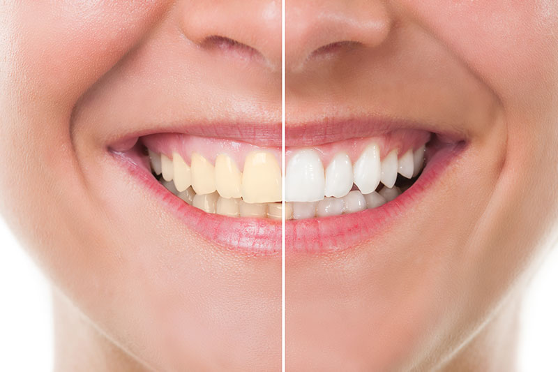 Teeth Whitening in Clovis
